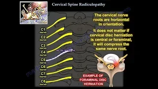 Cervical Radiculopathy - Everything You Need To Know - Dr. Nabil Ebraheim