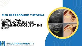 Hamstring ultrasound - Semimembranosus and Semitendinosus tendons and using Anistropy