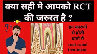 क्या आपको सही मे rct की जरूरी है? कब RCT की जरुरत होती है ? Root canal treatment