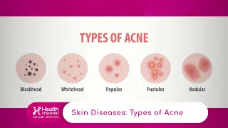 Types of Acne