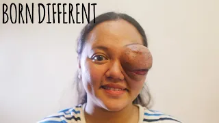 I Lost My Eye To A Tumour | BORN DIFFERENT