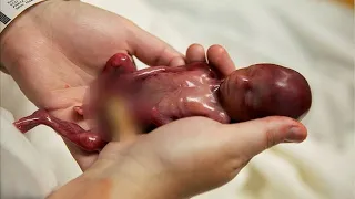 Bebê nasce com 19 SEMANAS e mãe o coloca em SEUS BRAÇOS de forma EMOCIONANTE!