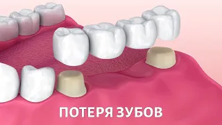 Потеря ЗУБОВ: каковы последствия и как с ними бороться?