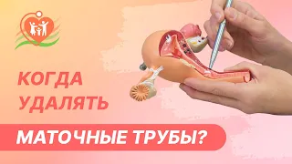 👩‍⚕️  Когда удалять маточные трубы?