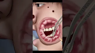 ASMR Cleaning big hole swollen face piercings | Removal animation 3#