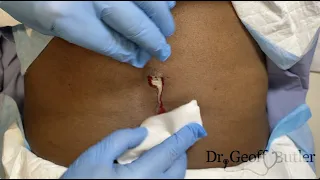 Drainage of an infected cyst on the back