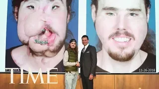 A Face Transplant Gave This 26-Year-Old A ‘Second Chance At Life’ | TIME