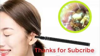 Ear wax removal #33