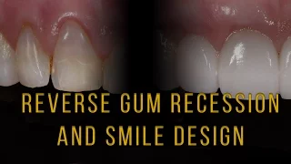 How to get gum recession back and Improve your smile with Porcelain Veneers