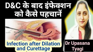 D&C के बाद इंफेक्शन के लक्षण और उपाय। Infection after Dilation and Curettage in Hindi