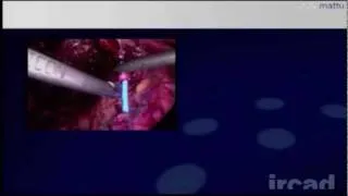 Laparoscopic Suturing