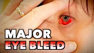 MAJOR EYE BLEED + (Possible Mono, Spleen Exam, & Blood Draw) | Dr. Paul