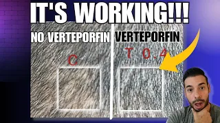 Verteporfin Potential Hair Loss Cure Human Clinical Trial Update- ITS WORKING!