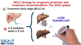 Barcelona Clinic Liver Cancer (BCLC) staging system. The 2022 update