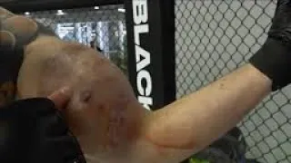 Al Popeye Ruso (Kirill Tereshin) le explota un brazo durante un combate de mma