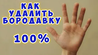 Как удалить бородавку - Я знаю способ 100%