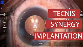 Synergy Intraocular Lens Insertion