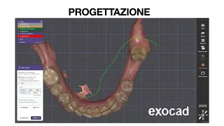 Implantologia digitale - ponte 3 elementi chirurgia robotica Xnav