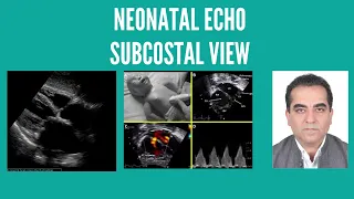 Neonatal echo-subcostal view. Dr Mohit Sahni #pocus #echo #subcostalview