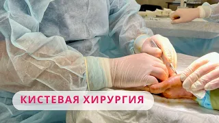 КИСТЕВАЯ ХИРУРГИЯ: МЕТОДЫ И ПОКАЗАНИЯ К ЛЕЧЕНИЮ