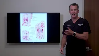 UPPP - Using thermal fusion & trimming the uvula / soft palate to treat Snoring/ Sleep Apnea