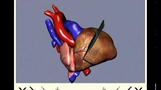 Virtual Open Heart Surgery