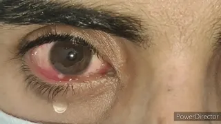 Phlyctenular keratoconjunctivitis CC34