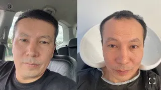 Результат пересадки волос в Bellus Clinic / видео отзыв от Шалкара из Казахстана
