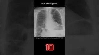 Chest X-ray Question 21