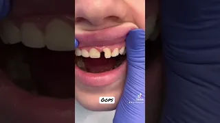 #tiktok #video #fyp #trending #dentist #viral #foryou #family #love #funny #broken tooth