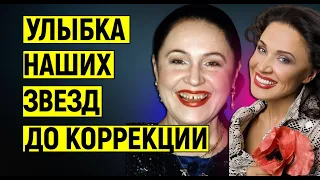Как выглядела улыбка российских звезд до коррекции зубов - до и после