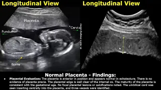 Placenta Ultrasound Reporting | How To Write Pregnancy USG Reports | Pathologies & Positions Scans