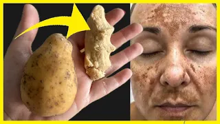 Shocking😮  in 7 Nights , I Wiped Off the Dark Spots on My Face with Ginger and Potato Face Cream