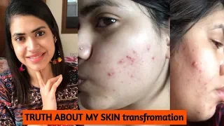 How I cleared my SKIN from ACNE & DARK SPOTS