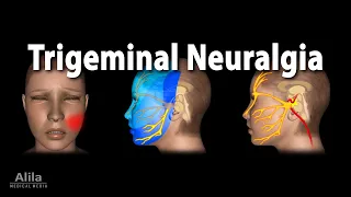 Trigeminal Neuralgia (Tic Douloureux), Animation