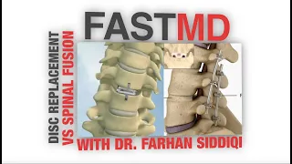 FASTMD Disk Replacement VS Spinal Fusion