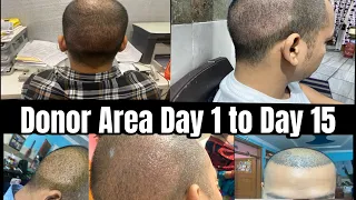 Donor Area recovery after hair transplant | Day 1 to 15