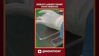 Watch: Sri Lankan Doctors Remove World's Largest Kidney Stone | #shorts