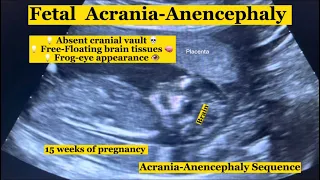 Fetal Acrania On Ultrasound  #ultrasoundscans #sexdetermination #medical #fetaldevelopment #anomaly