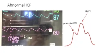 ICP Monitoring for Neurosurgery Residents