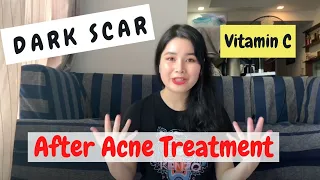 3 Reasons Why You Got Dark Scar After Acne Treatment at Spa-Solutions/Thâm Sẹo Sau Nặn Mụn-Giải Pháp