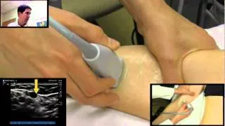 IV Placement Ultrasound from One Minute Ultrasound