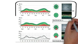 Optical Coherence Tomography - OCT | part-1