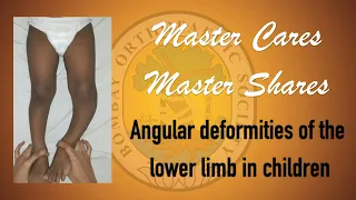 Master Shares Master Cares - Angular deformities of lower limb in children