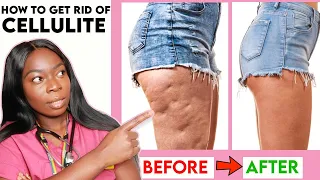How to get rid of CELLULITE on your THIGHS, LEGS & BUTT? Home Remedies|Workout | Creams & more