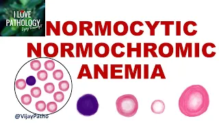 NORMOCYTIC NORMOCHROMIC ANEMIA.   Causes, Mechanism & Approach