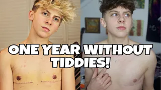 TOP SURGERY RESULTS ONE YEAR POST OP (FTM TRANSGENDER) | NOAHFINNCE