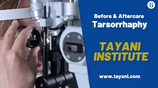 Before & After Tarsorrhaphy Surgery | Tayani Institute