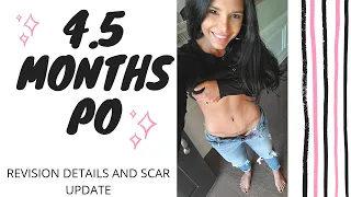 4.5 Months PO - MOMMY MAKEOVER UPDATE!!! Sharing details about revision and scar update.