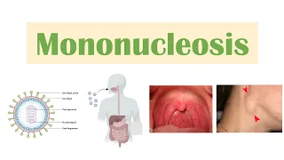 Infectious Mononucleosis (Mono) | Epstein-Barr Virus, Transmission, Symptoms, Diagnosis, Treatment